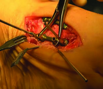 Here one can see fixed-angle locking plates and screws across the normal anatomic contours of the second and third TMTs, and the plates rest on the midline of the bones.