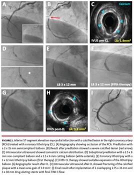 Inferior ST-segment elevation myocardial infarction with a calcified lesion in the right coronary artery (RCA) treated with coronary lithotripsy (CL).