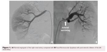 Figure 1 Normal angiogram