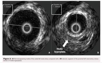Figure 2 Media hyperplasia