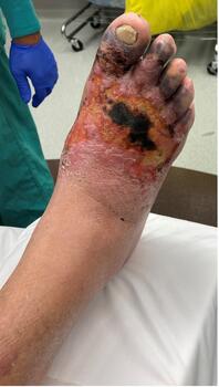 Here one can see active soft tissue necrosis in the case discussed.