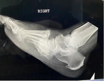 Here one can see the radiographic image of the neuropathic dislocation.