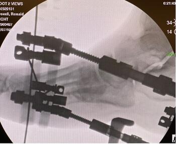 Here one can see a radiographic image of the Charcot reconstruction.