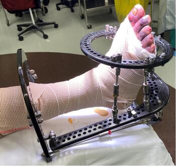 This postop image shows the triplanar external fixator.