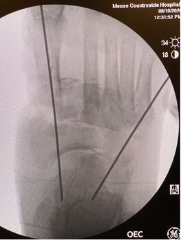 Note the fluoroscopic image of pinning of the tarsometarsal joint.