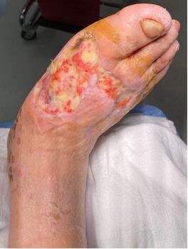 The wound underwent multiple debridements and graft applications.