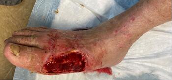 This image represents the clinical appearance two months after removing the second graft.