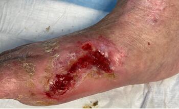 The wound continued to improve with care as seen in this image.