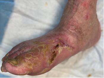 Here one can see resolution of the initial wound.