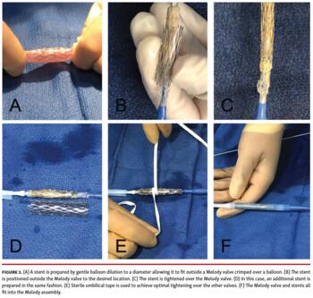 Simultaneous stenting during Melody valve implantation is achieved by some slight modifications to the typical set-up.