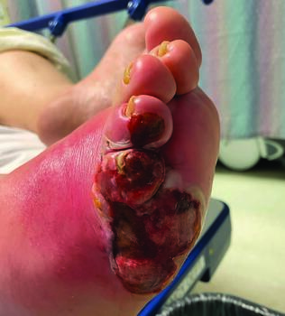 Although recent research suggests that VPT combination therapy, often used for empiric antibiotic therapy in diabetic foot infections as seen here, strongly associates with AKI development, the mechanism by which this happens is not clearly understood.