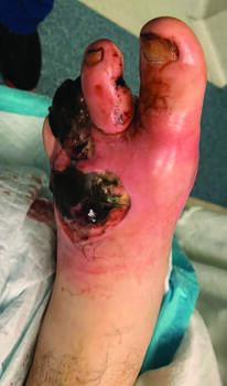 According to the evidence presented by the authors, cefepime and meropenem have a lower risk of AKI and provides similar coverage to a piperacillin/tazobactam combination as part of empiric antibiotics for diabetic foot infection.