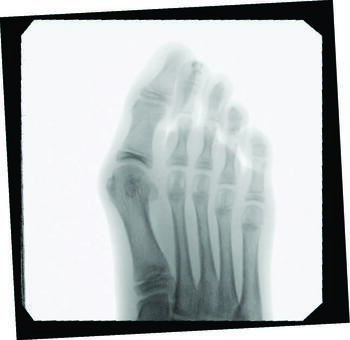 This radiographic image depicts a case of hallux abducto valgus in a pediatric patient. Approximately 36 percent of the pediatric population has this condition.