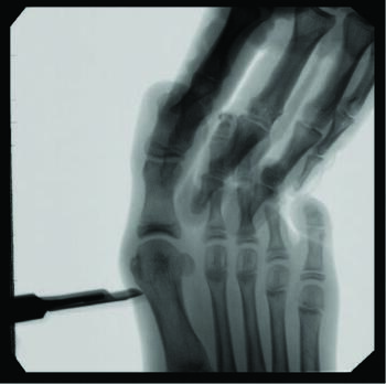 A minimally invasive surgical approach to pediatric hallux abducto valgus involves a small stab incision medially at the first metatarsal neck, as seen here.