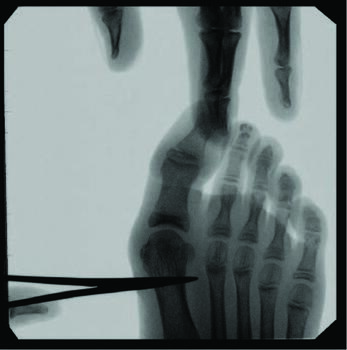This intraoperative radiograph shows subperiosteal dissection starting from the medial bone surface, extending laterally in dorsal and plantar directions.