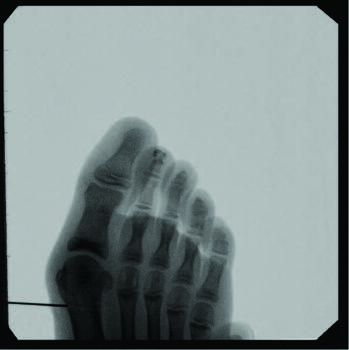 One performs the minimally-invasive osteotomy in the technique described by the author using multiple drill hole technique or a burr.