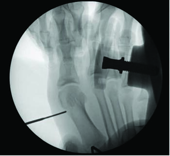 The author shares the importance of the osteotomy taking place intracapsularly and just proximal to the sesamoid in order to maintain a stable construct.
