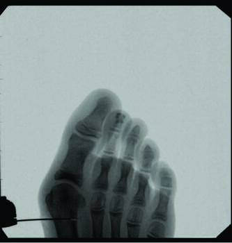 Here one sees a transverse cut made at the metatarsal neck with a high torque, low speed burr, blade, or osteotome, which preserves the capsule and vascular plexus.