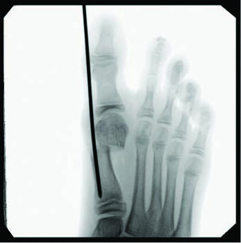 Here one sees buttressing of the translated capital fragment against a Steinmann pin. When fixating, one should avoid the proximal growth plate.