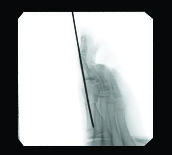 The author advises reviewing fixation placement and capital fragment translation in multiple planes before closure.