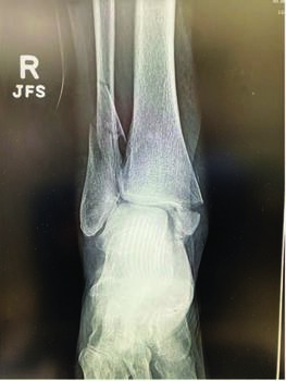 This radiographic image exhibits a closed trimalleolar ankle fracture. The authors advocate for mastery of open procedures as a base for MIS techniques.