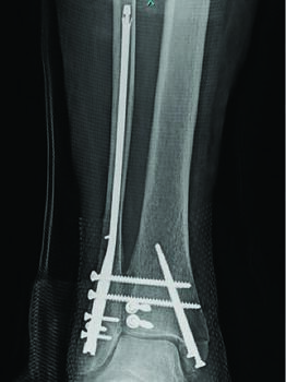 Here one can see the same fracture as to the left, treated with intramedullary fibular fixation, percutaneous malleolar reduction and pinning.