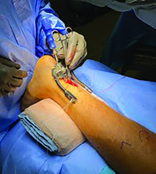 This intraoperative photo shows a minimalincision technique for repair of an Achilles tendon rupture. The author points out that patient selection is key.
