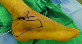 This photo illustrates the sinus tarsi incisional approach for calcaneal fractures. This allows adequate visualization of the calcaneal posterior facet and introduction of locking plates configured for the posterior facet. One can often visualize the peroneal tendons and the surgeon must take care to identify the sural nerve.