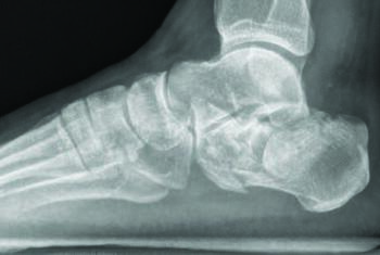This X-ray shows a preop image of a calcaneal fracture addressed using minimally invasive principles.