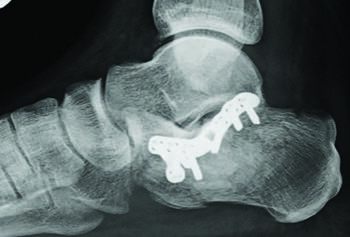 This X-ray shows a postop image of a calcaneal fracture addressed using minimally invasive principles.