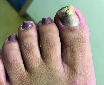 This photo exhibits a hallux nail undergoing currently successful treatment after three months of an oral antifungal. Clear nail is visible at the proximal aspect.
