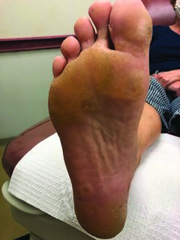 In this photo, one can see a pedal presentation of porokeratosis palmaris et plantaris disseminata.