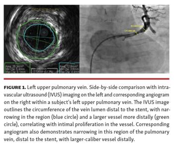 Heyden Benefits of IVUS in Pediatric Interventional Cardiology Fig 1
