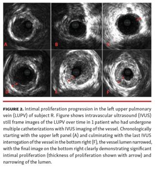 Heyden Benefits of IVUS in Pediatric Interventional Cardiology Fig 2