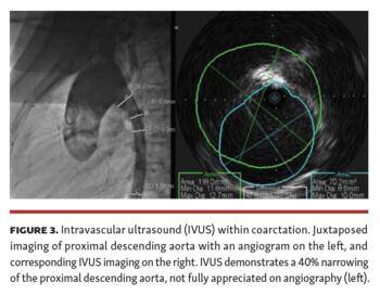 Heyden Benefits of IVUS in Pediatric Interventional Cardiology Fig 3