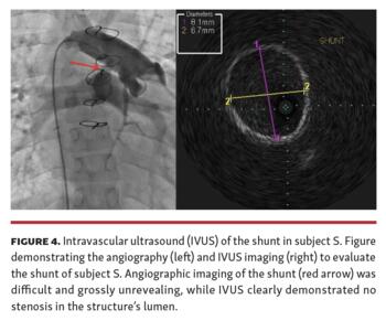Heyden Benefits of IVUS in Pediatric Interventional Cardiology Fig 4