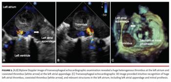 Lin Ping Pong Thrombus Figure 1
