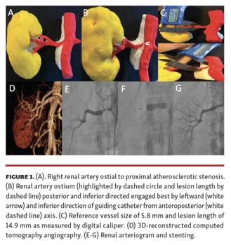 Memon 3D Printing of Renal Arteries for Endovascular Interventions Figure 1