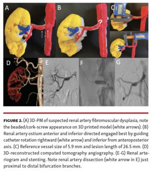 Memon 3D Printing of Renal Arteries for Endovascular Interventions Figure 2