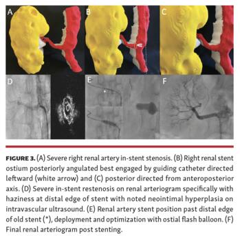 Memon 3D Printing of Renal Arteries for Endovascular Interventions Figure 3