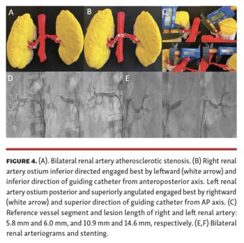 Memon 3D Printing of Renal Arteries for Endovascular Interventions Figure 4