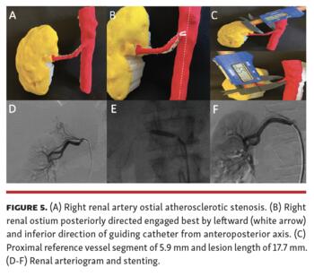 Memon 3D Printing of Renal Arteries for Endovascular Interventions Figure 5