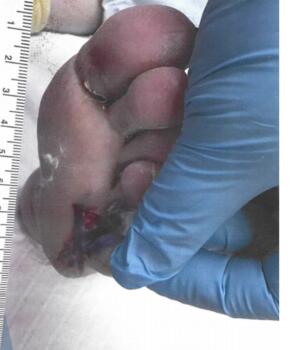 The wound between the fourth and fifth rays was granular with erythematous periwound tissue.