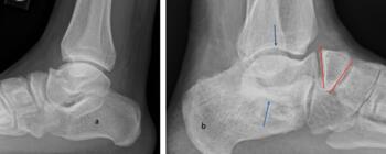 Soldiers medically discharged: a. Short talar body with deformed navicular (Turco release) b. Arrows show the abnormal ankle and subtalar joints and wedge shaped navicular which is very common (Cincinnati release)