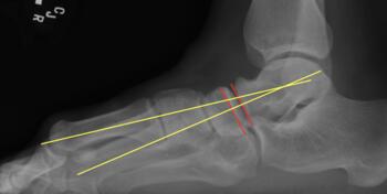 This image shows a classic met primus elevatus as a result of aggressive casting. So often the medial column elevates as a result of equinus. There is also flattening of the talonavicular joint. 