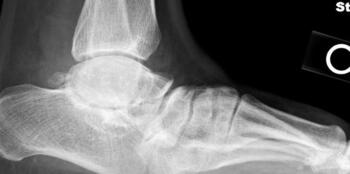 Rocker-bottom foot post Cincinnati release in a 25-year-old trainee.