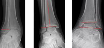 a. Often cases will develop hypertrophy of the fibula, note the width of the fibula. b. Ankle varus deformity. c. Abnormal talocrural ankle with short fibula.