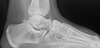 Marine post-Cincinnati release who was medical discharged due to inability to run.