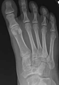 Marine post-Cincinnati release who was medical discharged due to inability to run.