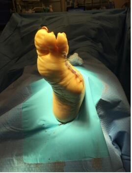 Here one can see the foot postoperatively after resection of the tissue.